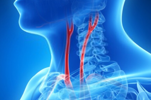 Enfermedad carotidea CDMX.