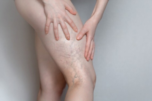 insuficiencia venosa crónica CDMX