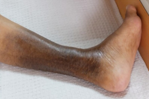 Isquemia crónica CDMX.