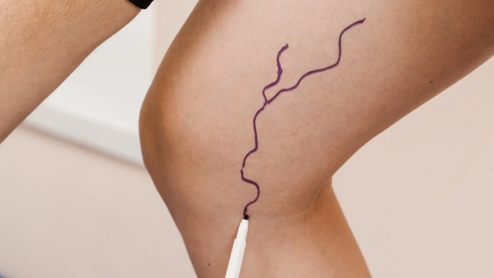 ¿Qué médico trata malformaciones vasculares?