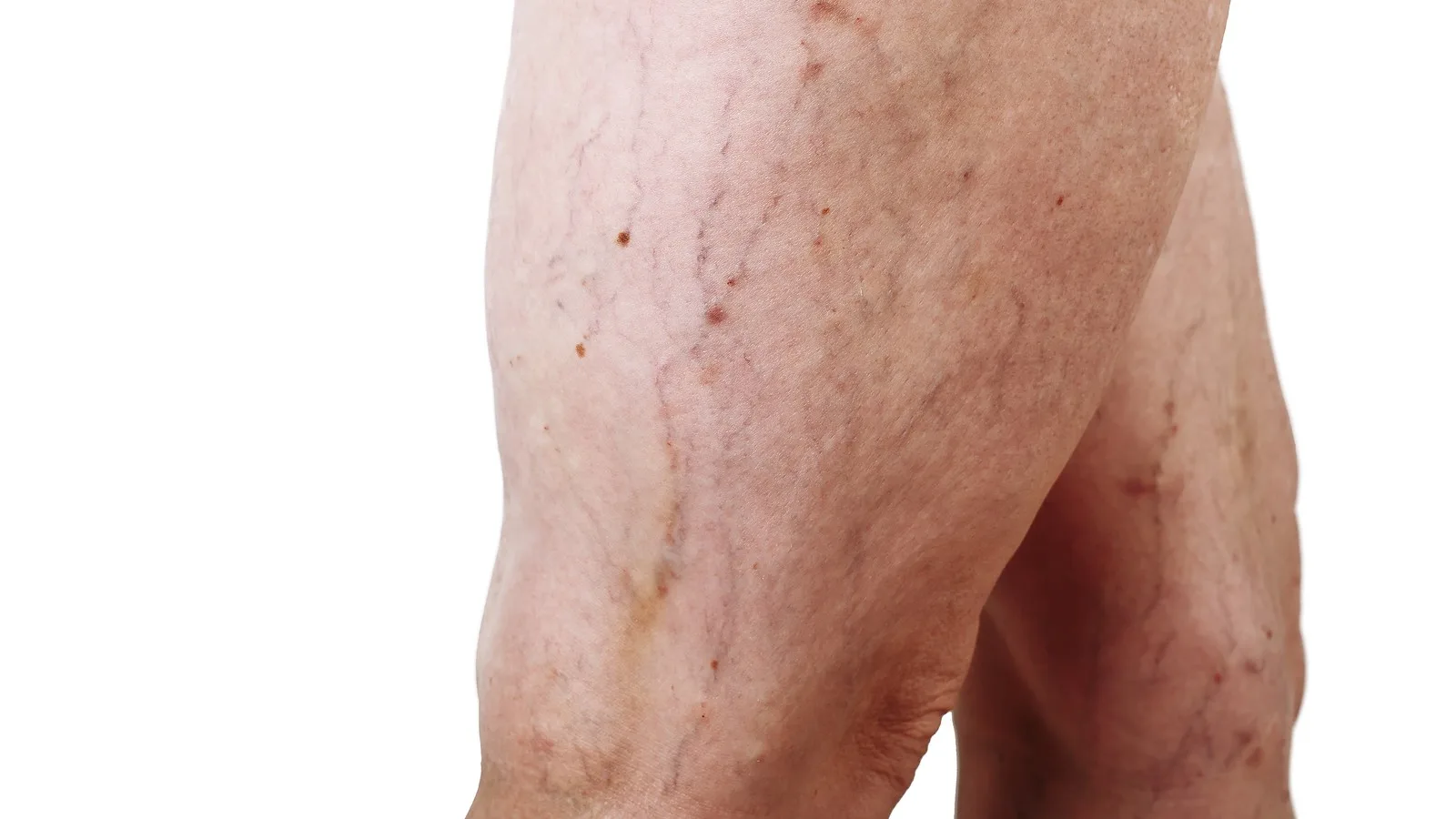 Especialista en problemas vasculares en CDMX