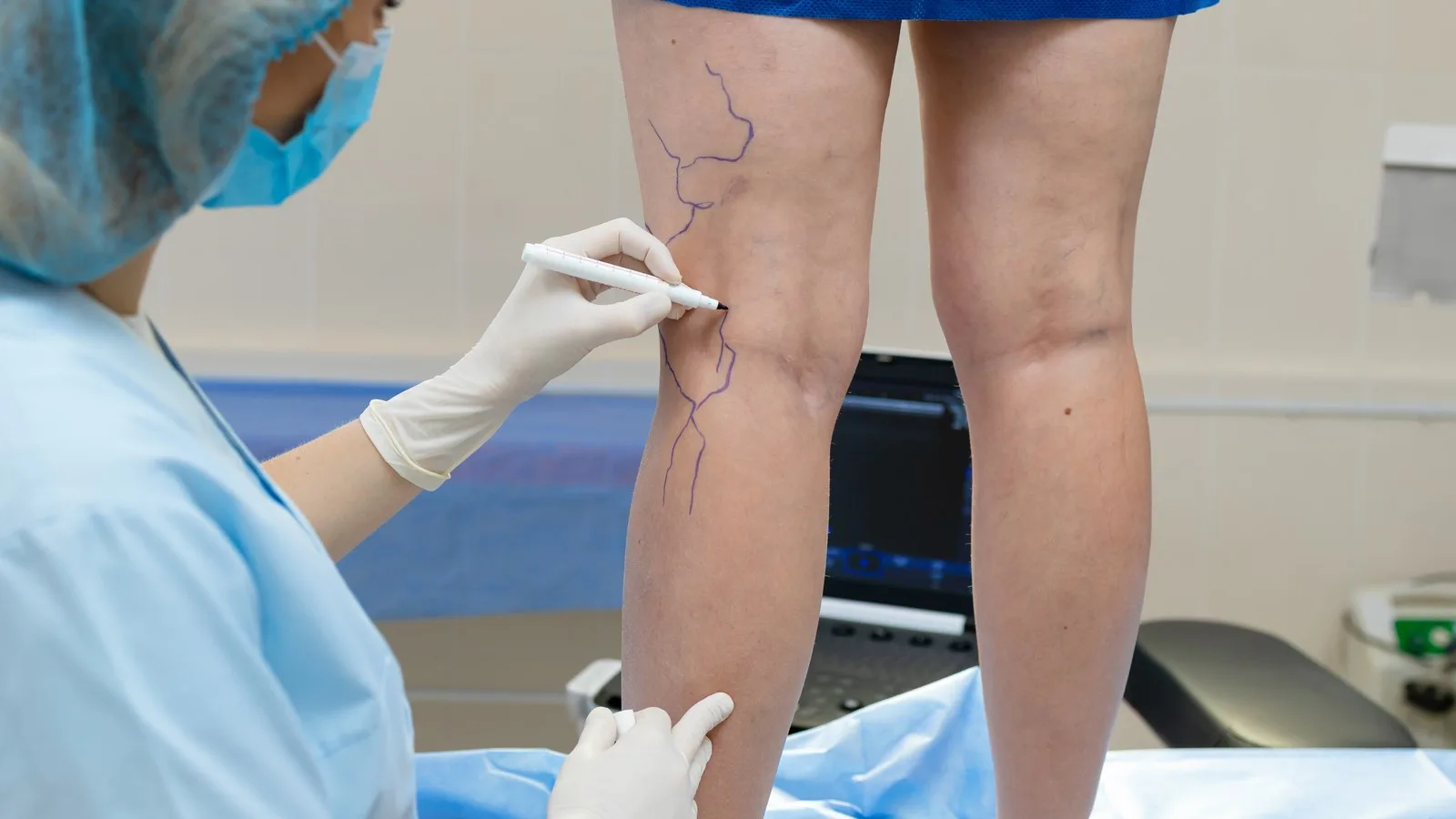 Especialista en trombosis venosa profunda en CDMX