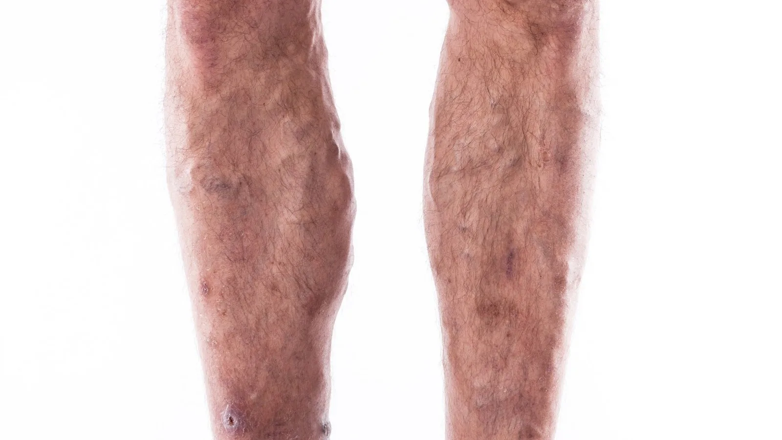 ¿Qué médico trata trombosis venosa profunda?